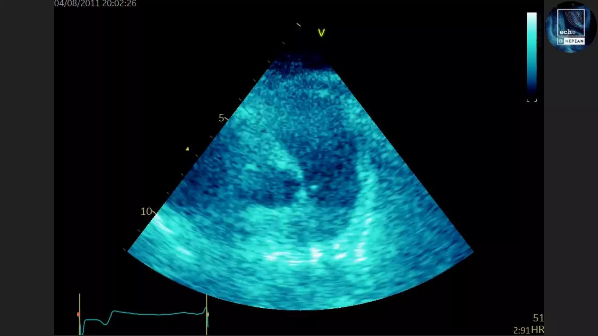 Echo in Cardiac Arrest | PPT