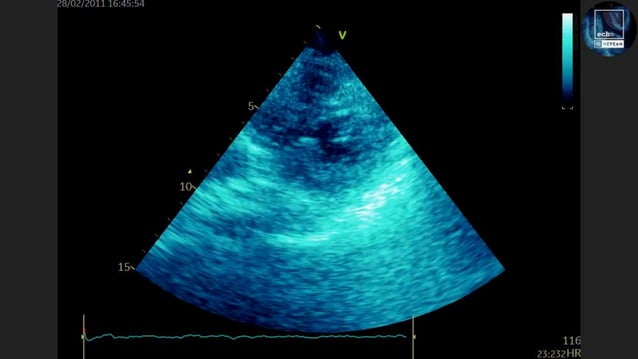 Echo in Cardiac Arrest | PPT