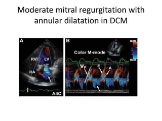 Moderate mitral regurgitation with
annular dilatation in DCM
 