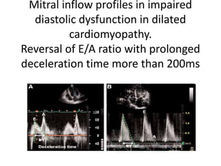 Mitral inflow profiles in impaired
diastolic dysfunction in dilated
cardiomyopathy.
Reversal of E/A ratio with prolonged
deceleration time more than 200ms
 