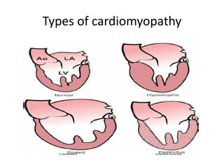 Types of cardiomyopathy
 