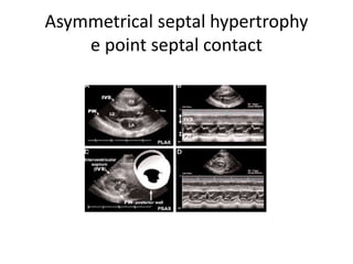 Asymmetrical septal hypertrophy
e point septal contact
 