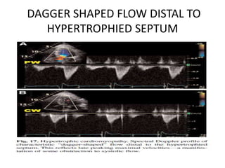 DAGGER SHAPED FLOW DISTAL TO
HYPERTROPHIED SEPTUM
 