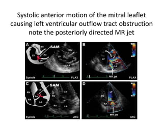 Systolic anterior motion of the mitral leaflet
causing left ventricular outflow tract obstruction
note the posteriorly directed MR jet
 