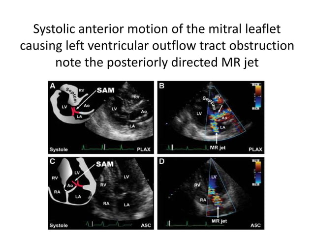 Echo Stem Inmotion Echo in hypertrophic obstructive cardiomyopathies | PPTX