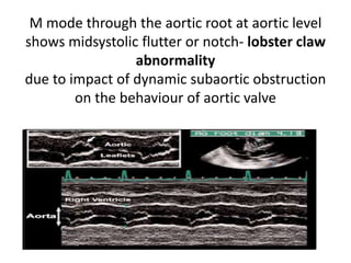 M mode through the aortic root at aortic level
shows midsystolic flutter or notch- lobster claw
abnormality
due to impact of dynamic subaortic obstruction
on the behaviour of aortic valve
 