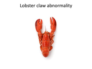 Lobster claw abnormality
 
