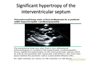 Significant hypertropy of the
interventricular septum
 