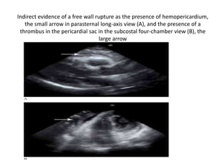 Indirect evidence of a free wall rupture as the presence of hemopericardium,
the small arrow in parasternal long-axis view (A), and the presence of a
thrombus in the pericardial sac in the subcostal four-chamber view (B), the
large arrow
 