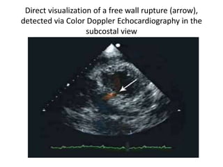 Direct visualization of a free wall rupture (arrow),
detected via Color Doppler Echocardiography in the
subcostal view
 