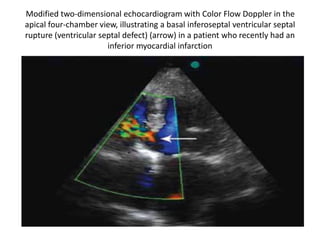 Modified two-dimensional echocardiogram with Color Flow Doppler in the
apical four-chamber view, illustrating a basal inferoseptal ventricular septal
rupture (ventricular septal defect) (arrow) in a patient who recently had an
inferior myocardial infarction
 