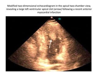 Modified two-dimensional echocardiogram in the apical two-chamber view,
revealing a large left ventricular apical clot (arrow) following a recent anterior
myocardial infarction
 