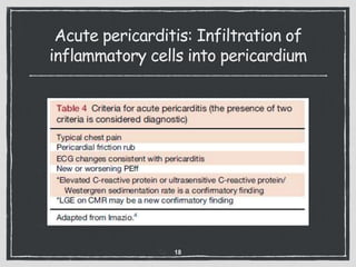 Acute pericarditis: Infiltration of
inflammatory cells into pericardium
18
 