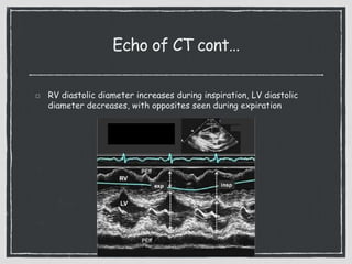 Echo of CT cont…
RV diastolic diameter increases during inspiration, LV diastolic
diameter decreases, with opposites seen during expiration
36
 