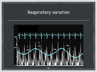 Respiratory variation
42
 