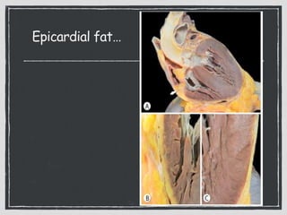 Epicardial fat…
8
 