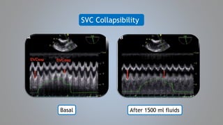 Svc Rupture Echocardiographic Evaluation of Shock States | PPTX