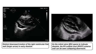 ECHOCARDIOGRAPHY IN CARDIAC TAMPONADE | PPTX