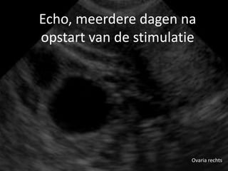 Echo, meerdere dagen na
opstart van de stimulatie




                        Ovaria rechts
 