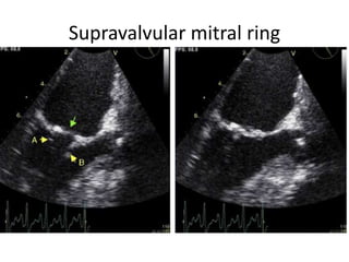 Supravalvular mitral ring
 