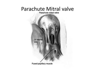Parachute Mitral valve
 