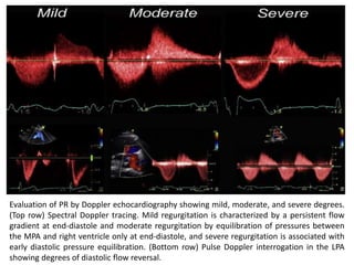 Evaluation of PR by Doppler echocardiography showing mild, moderate, and severe degrees.
(Top row) Spectral Doppler tracing. Mild regurgitation is characterized by a persistent flow
gradient at end-diastole and moderate regurgitation by equilibration of pressures between
the MPA and right ventricle only at end-diastole, and severe regurgitation is associated with
early diastolic pressure equilibration. (Bottom row) Pulse Doppler interrogation in the LPA
showing degrees of diastolic flow reversal.
 