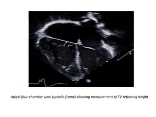 Apical four-chamber view (systolic frame) showing measurement of TV tethering height
 