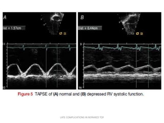 LATE COMPLICATIONS IN REPAIRED TOF
 