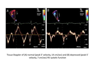 Tissue Doppler of (A) normal (peak S’ velocity, 14 cm/sec) and (B) depressed (peak S’
velocity, 7 cm/sec) RV systolic function
 