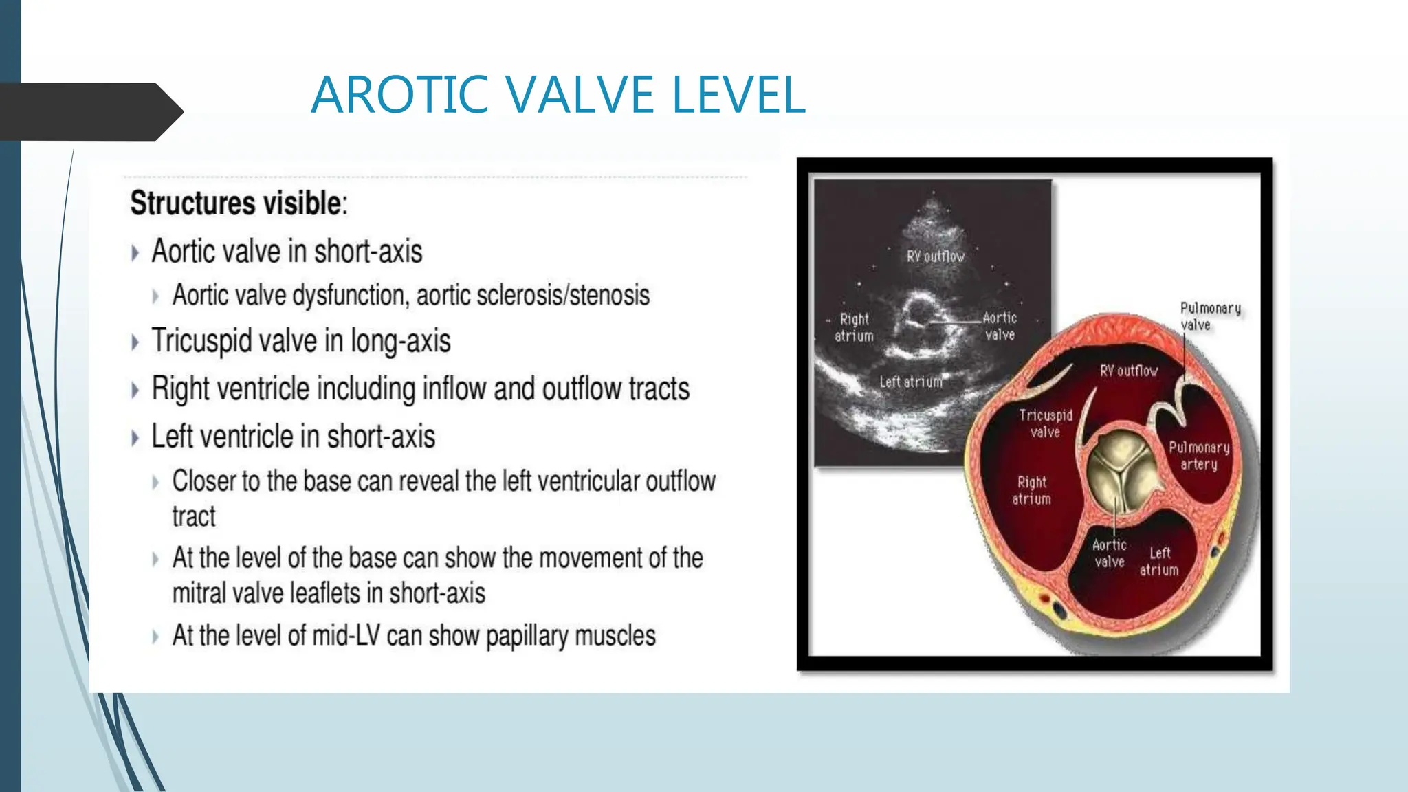 AROTIC VALVE LEVEL
 