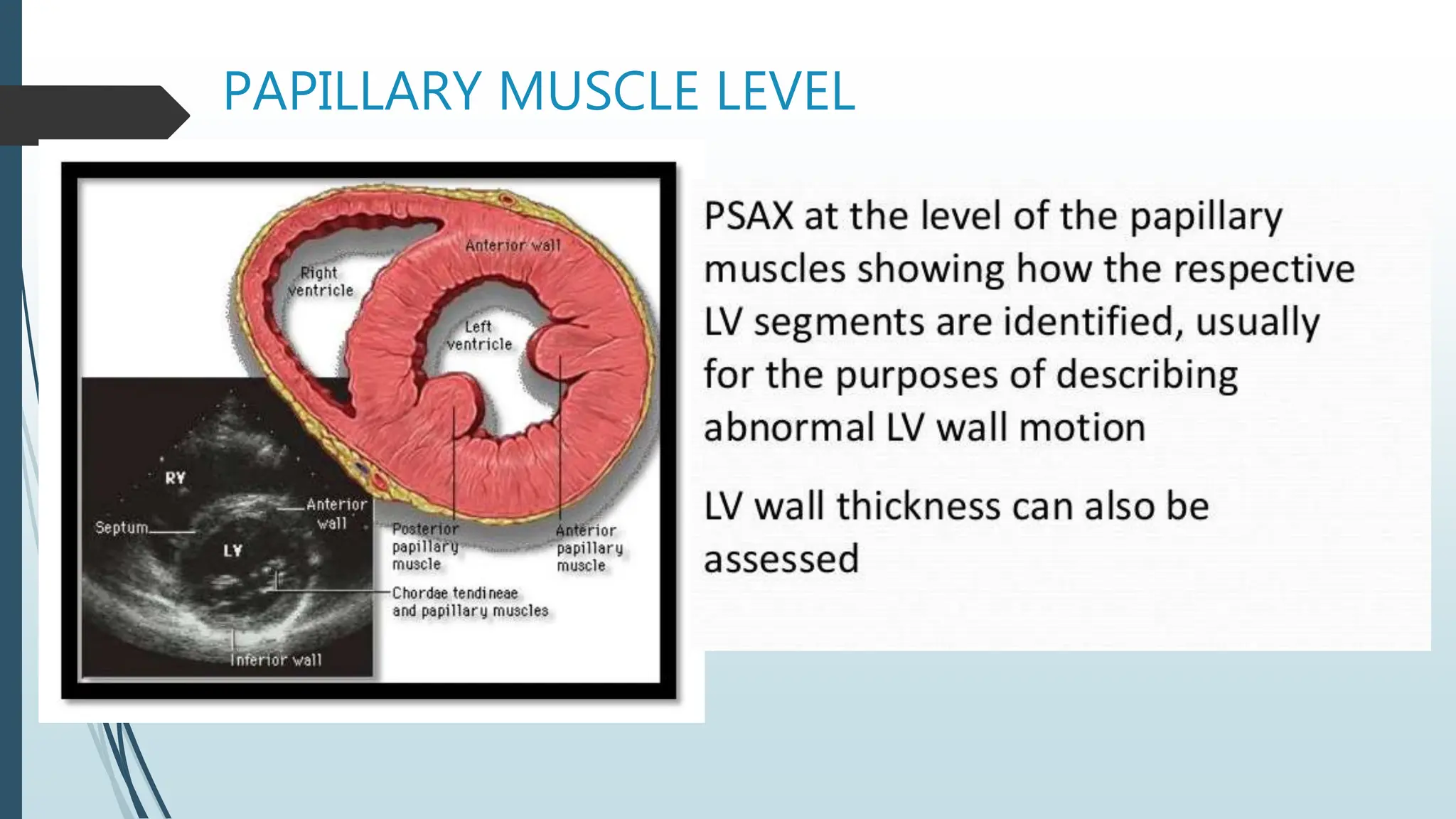 PAPILLARY MUSCLE LEVEL
 