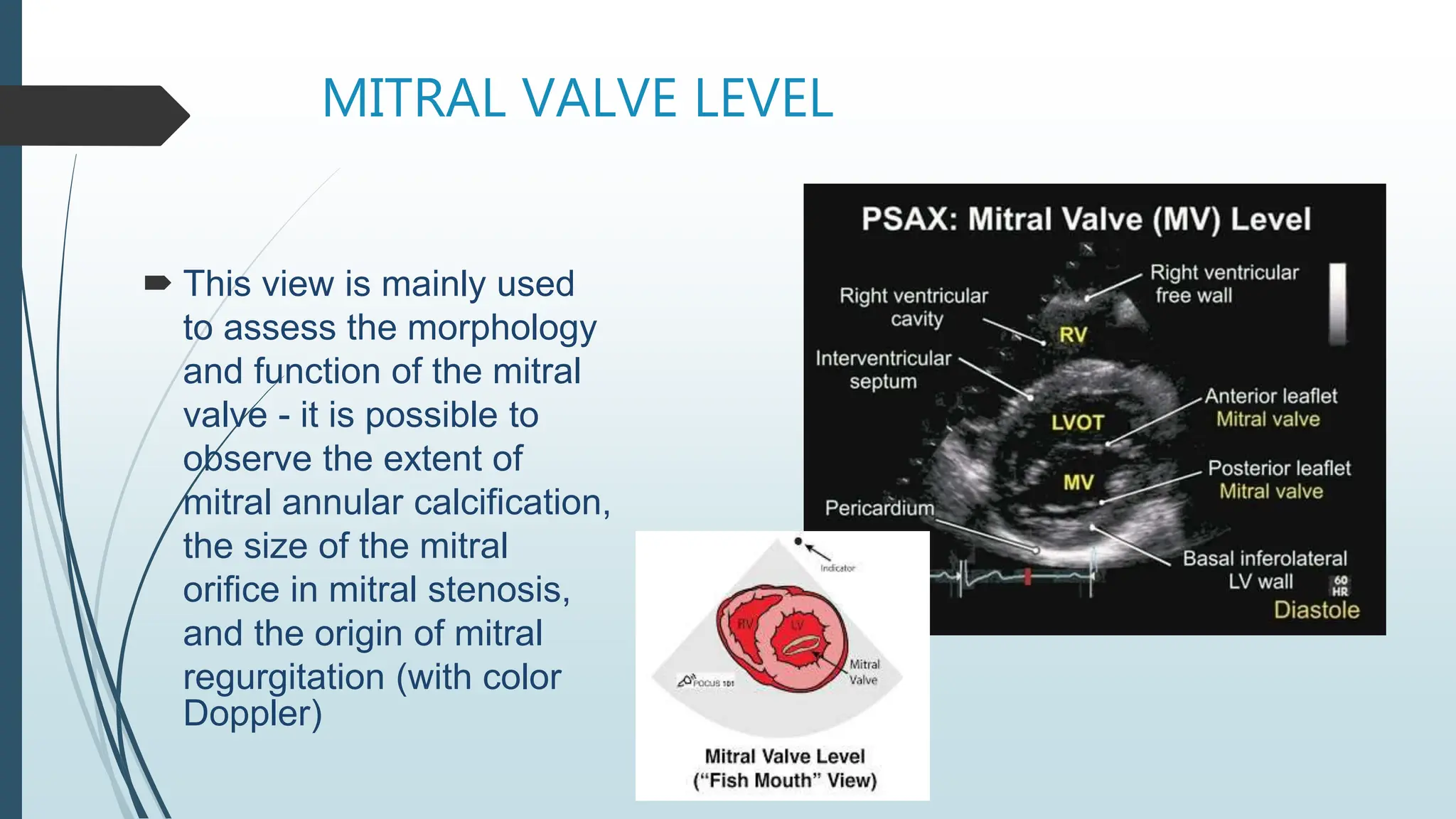 MITRAL VALVE LEVEL
 This view is mainly used
to assess the morphology
and function of the mitral
valve - it is possible to
observe the extent of
mitral annular calcification,
the size of the mitral
orifice in mitral stenosis,
and the origin of mitral
regurgitation (with color
Doppler)
 