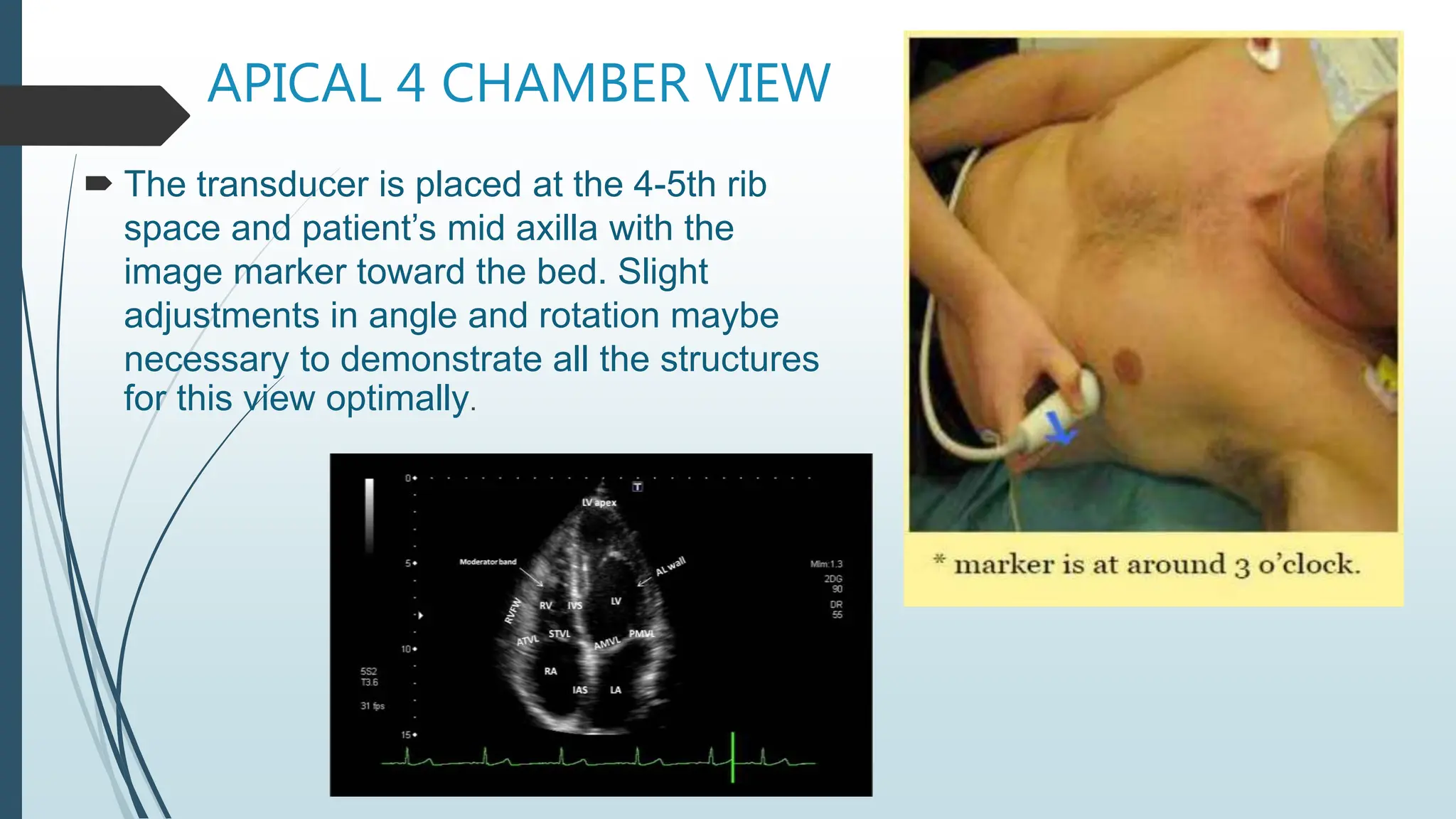 APICAL 4 CHAMBER VIEW
 The transducer is placed at the 4-5th rib
space and patient’s mid axilla with the
image marker toward the bed. Slight
adjustments in angle and rotation maybe
necessary to demonstrate all the structures
for this view optimally.
 