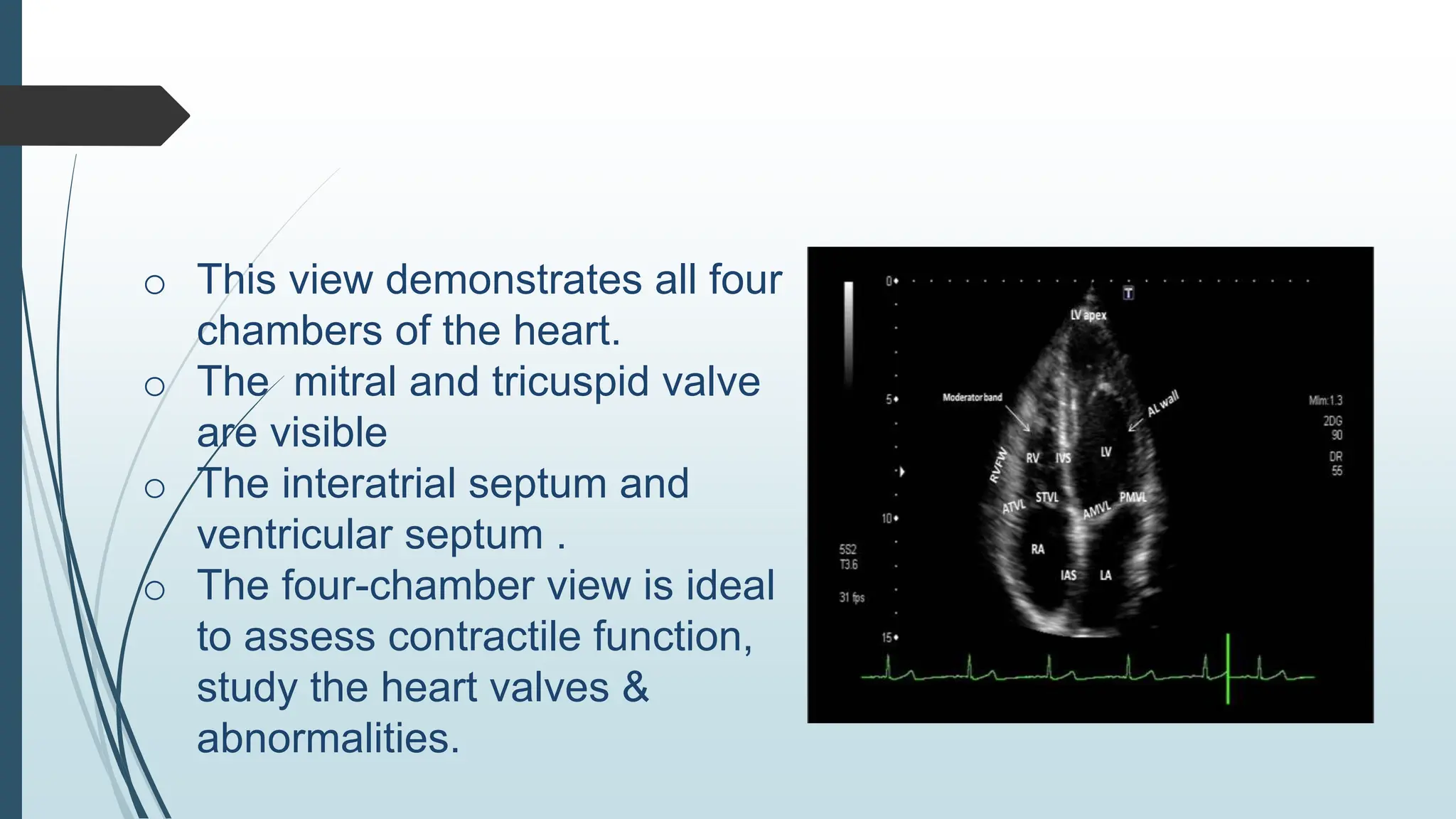 o This view demonstrates all four
chambers of the heart.
o The mitral and tricuspid valve
are visible
o The interatrial septum and
ventricular septum .
o The four-chamber view is ideal
to assess contractile function,
study the heart valves &
abnormalities.
 