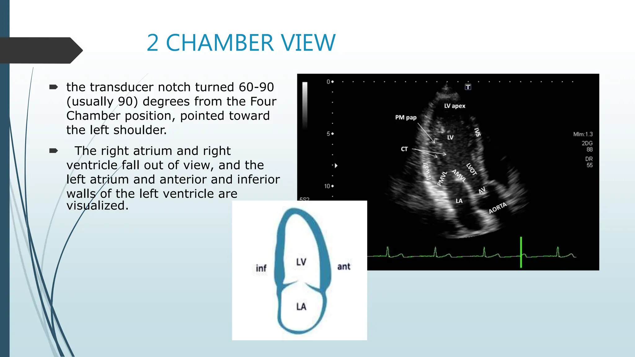 2 CHAMBER VIEW
 the transducer notch turned 60-90
(usually 90) degrees from the Four
Chamber position, pointed toward
the left shoulder.
 The right atrium and right
ventricle fall out of view, and the
left atrium and anterior and inferior
walls of the left ventricle are
visualized.
 