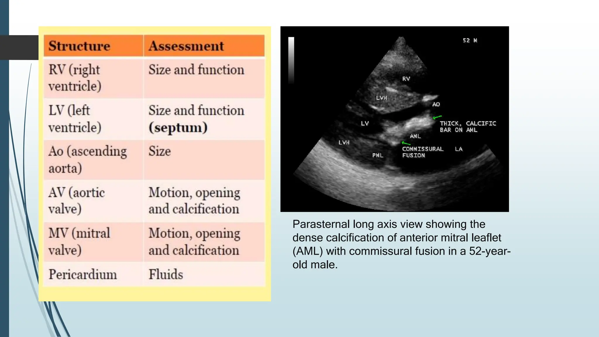 Parasternal long axis view showing the
dense calcification of anterior mitral leaflet
(AML) with commissural fusion in a 52-year-
old male.
 