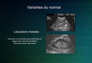 Variantes du normal
Lobulations foetales
Incisures ou encoches peu profondes en
regard des colonnes de Bertin
Zones de fusion des lobes
 