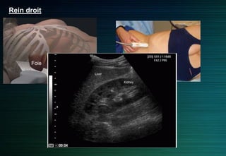 Rein droit
Foie
Rein
 