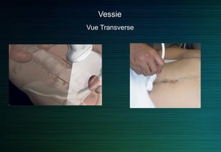 Reins
Mesure de la taille du rein
Variabilité inter/ intra observateurs
Erreurs par défaut
Plus grande dimension longitudinale
axe bivalve oblique en bas et dehors
 répéter 3 fois la même mesure si < 11cm
 