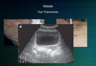 Vessie
Vue Transverse
 