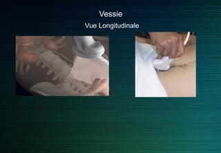 Vessie
Vue Transverse
 