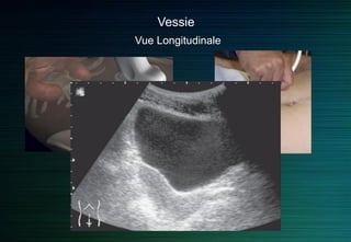 Vessie
Vue Longitudinale
 