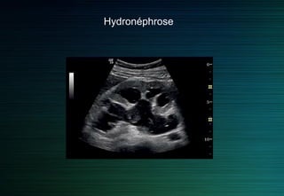 Globe vésical : la vessie devient sphérique
 