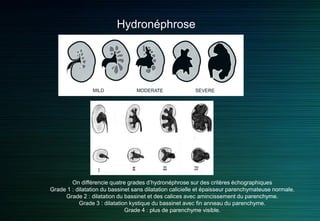 Hydronéphrose
 