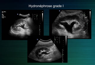Hydronéphrose
On différencie quatre grades d’hydronéphrose sur des critères échographiques
Grade 1 : dilatation du bassinet sans dilatation calicielle et épaisseur parenchymateuse normale.
Grade 2 : dilatation du bassinet et des calices avec amincissement du parenchyme.
Grade 3 : dilatation kystique du bassinet avec fin anneau du parenchyme.
Grade 4 : plus de parenchyme visible.
 