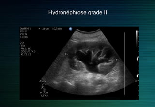 Hydronéphrose grade I
 