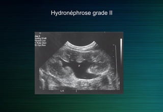 Hydronéphrose grade II
 