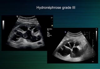 Hydronéphrose grade II
 