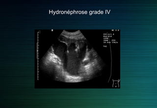 Hydronéphrose grade III
 