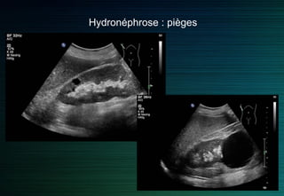 Hydronéphrose grade IV
 